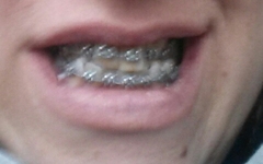 Adult braces anyone?