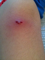 DS's very sore and painful spot