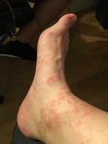 Heat rash, bites or something else?