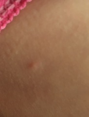 Does this look like chicken pox? (Photos included)