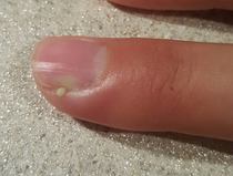 Er, my finger looks like it is going green. <pic!>