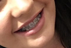 Adult braces anyone?