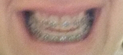 Adult braces anyone?