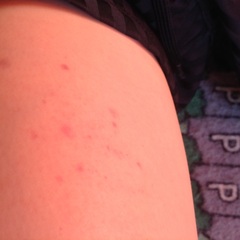 Speckle Bruise on Nine Year Old's Legs - Any Ideas?!