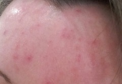 Foundation to cover lots of spots?