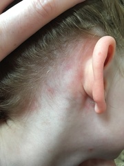 Does this look like chicken pox? (Photos included)