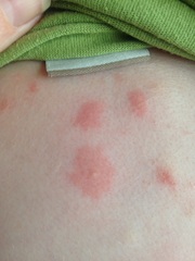 Does anyone recognise these bites?