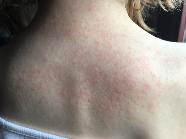 Does this look like an allergy rash?