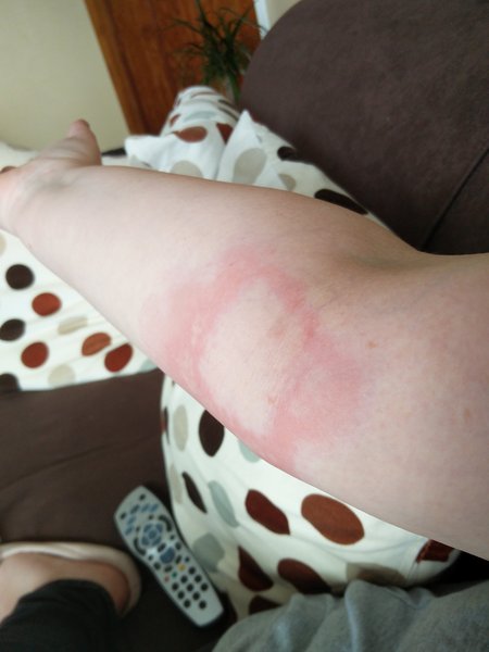 Allergic reaction to insect bite