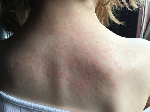 Is this an allergy rash?