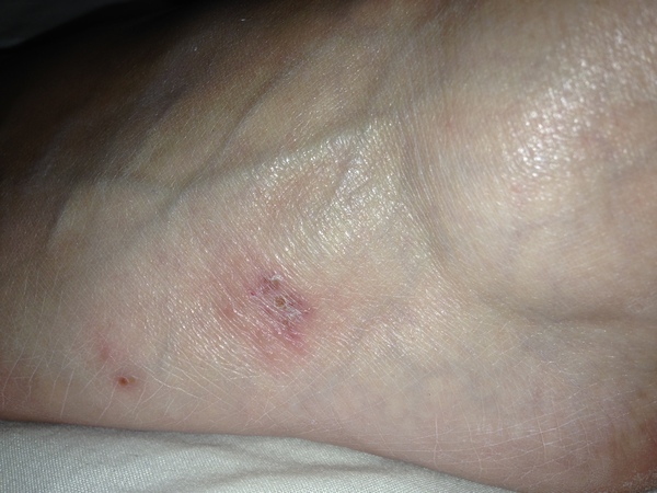 To ask if this could be shingles?