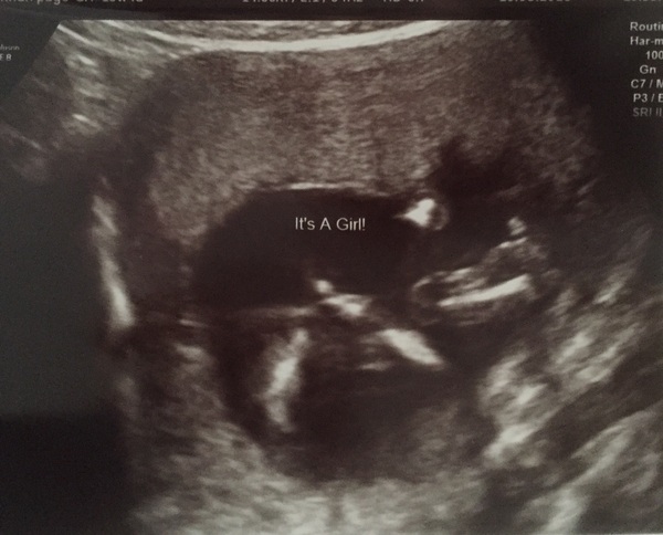 Gender scan... told it was a girl. Thoughts please?