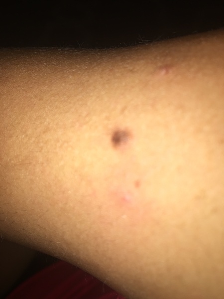 Mole(pictures)