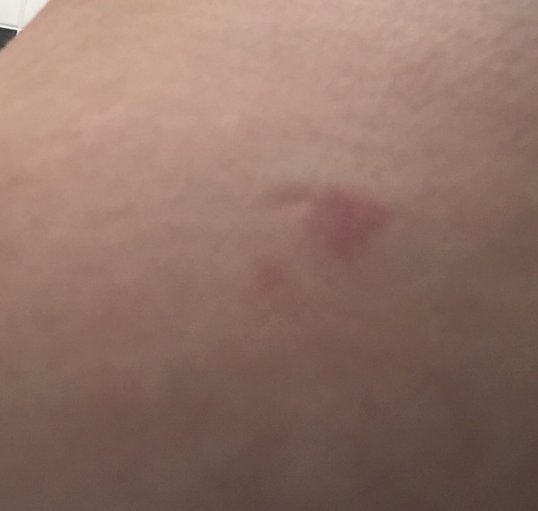 Mark / spot / change to my breast. Bit freaked