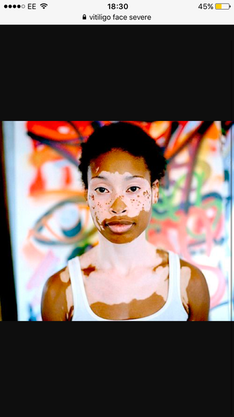 Vitiligo? Or just normal scab behaviour. Terrified.