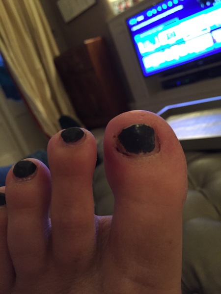 Infected toe! Would you mag sulpha it?