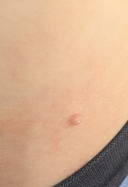 Wart? Skin tag?