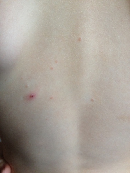molluscum contagiosum  Help!