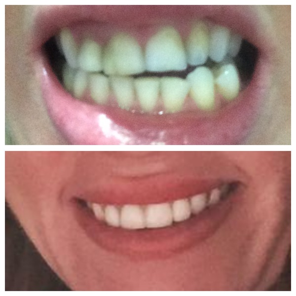 Cosmetic dental treatment
