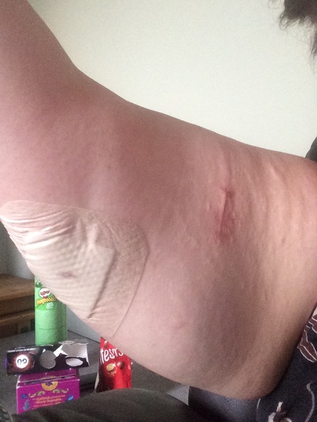 AIBU to think my arm was bloody mutilated??