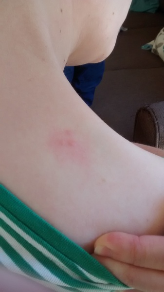 Does this look like bed bug bites?!