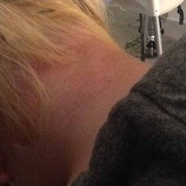 Hairdresser burnt scalp banana roots