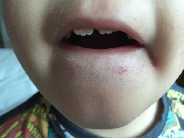 Rash on ds2s face... What the hell is it!?