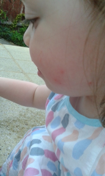 Cat scratch, potential for tetanus?