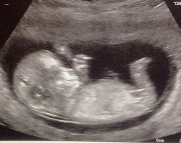 Guesses on Gender - 12 week scan
