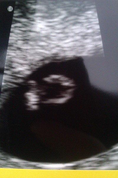 Scan at 6+2. What to expect?