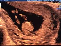 Sex of the baby?