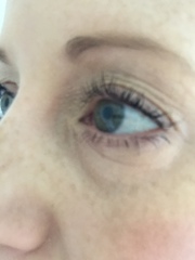 What is going on with skin around my eyes (pics included)