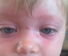 Rash on toddler's face