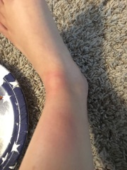 Are these Bug bites (pictures)