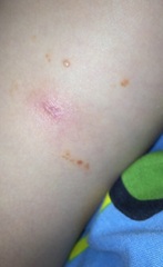 Molluscum question...again! Normal?