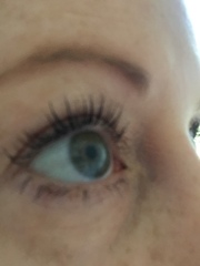 What is going on with skin around my eyes (pics included)