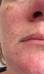 Face skin issue (pics) maybe rosacea