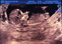 Sex of the baby?