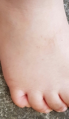 Curly toes