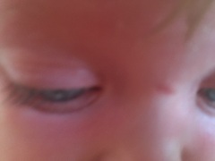Rash on toddler's face