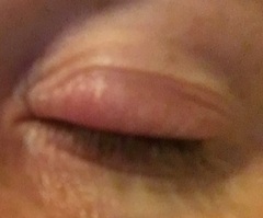 Is this a Stye? Pics in thread