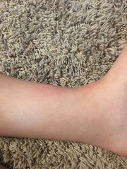 Are these Bug bites (pictures)
