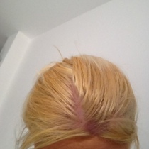 Hairdresser burnt scalp banana roots