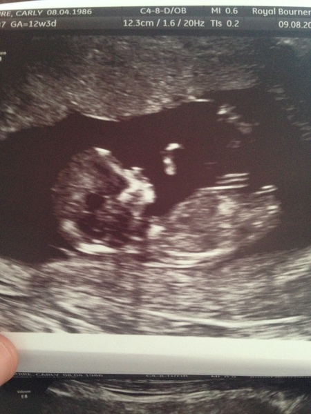 Can you ever tell the sex at 12 week scan?