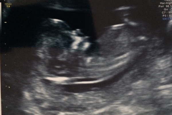 April 2017 #4 More baby scans, less morning sickness!