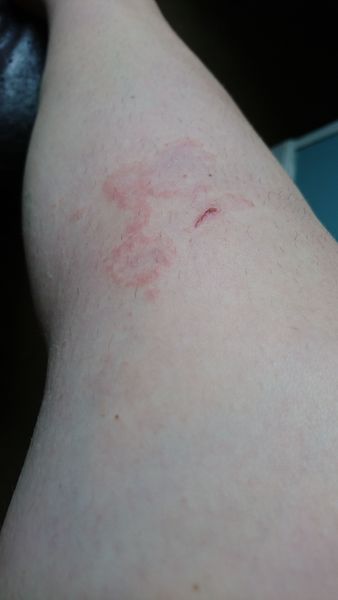 Talk to me about shingles. Because I've fucking got it :(