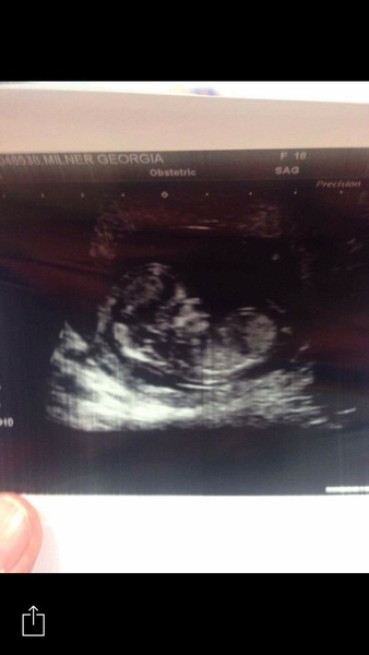 Missed Miscarriage
