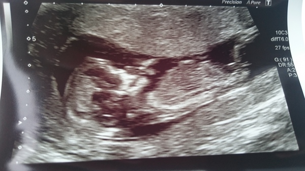 Due in March 2017 - thread #4