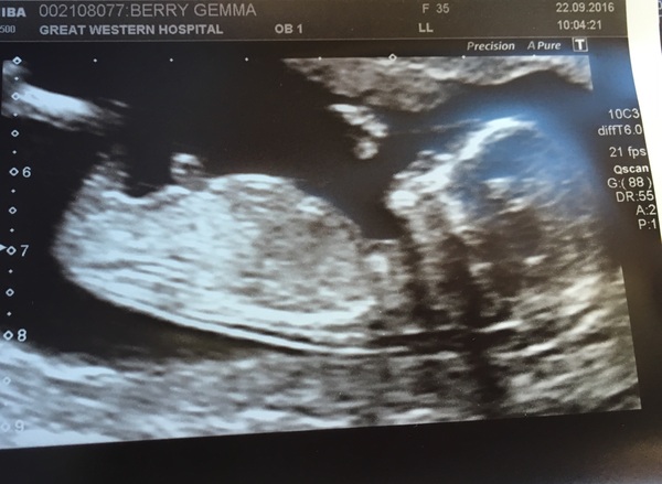 April 2017 #4 More baby scans, less morning sickness!