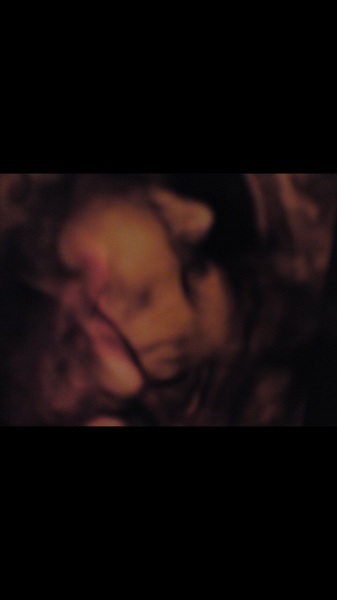Do you recommend a 4D scan?